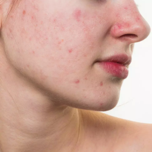 Acne and Scar Treatment at Dr. Alok Mehta Clinic