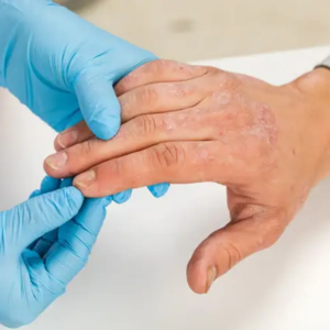 Psoriasis and Eczema Treatment Clinic in Borivali East