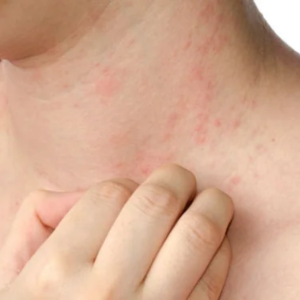 Urticaria Treatment Clinic in Borivali East